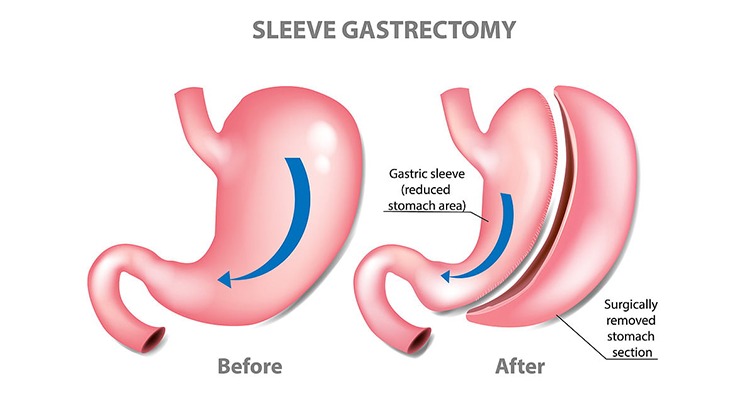 Sleeve Gastrectomy Image